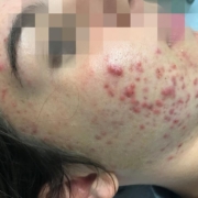 Acne cose come curarla